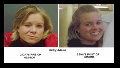 Kathy before and after MVD