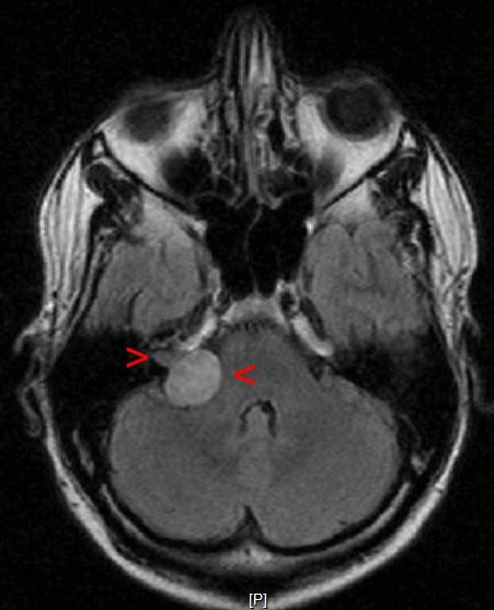 An acoustiic neuroma on the left side of this brain scan.