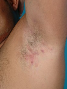 Hidradenitis suppurativa in the armpit
