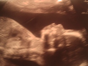 My Unborn Son Drake - 20 Week Sonogram