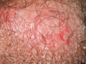 Inverse Psoriasis