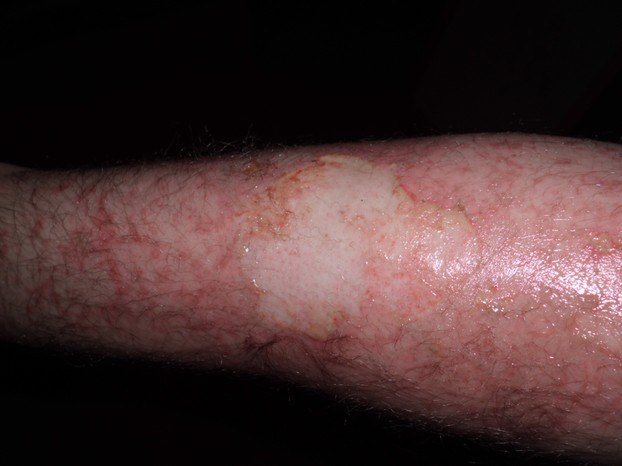 24 hours after fire (covered in Neosporin)