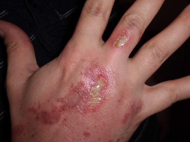 yea, it hurts (Jerrico's hand) this is 3 days later (looks like I'm a lizard under there)