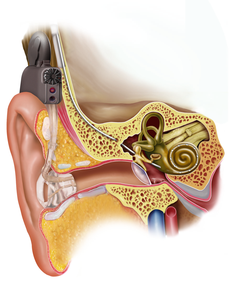 A cochlear implant transmits sounds directly to the brain.