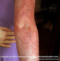 My Allergic Skin During Flare Up