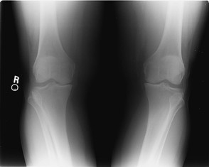 X-Ray of My Knees, 2006