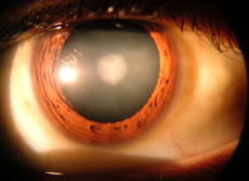 cataract picture