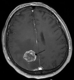 Brain tumor (MRI image)