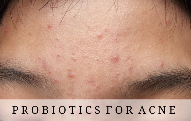 Probiotics for Acne