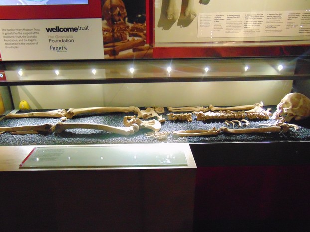 Skeleton with signs of Paget's Disease