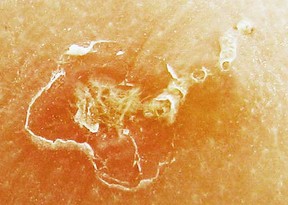 sbaies mite burrowing under skin